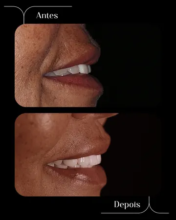 Post de antes e depois de tratamento, vista lateral.